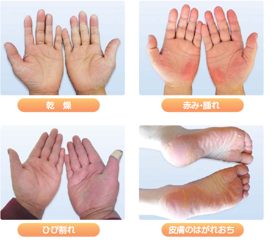 手足症候群　爪