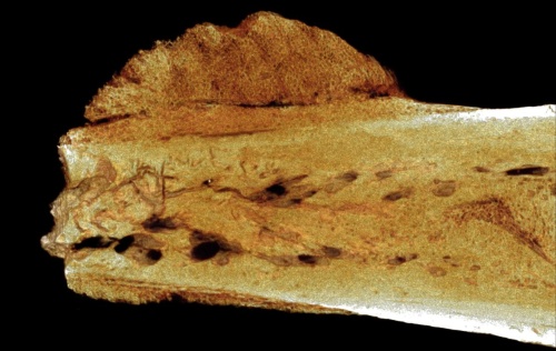 170万年前のヒト化石に最古のがん発見
