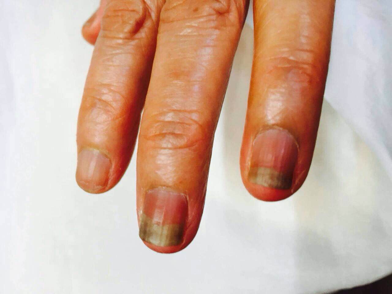 手足症候群　抗がん剤治療中の爪の黒ずみ