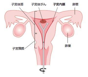 子宮体がんの検査